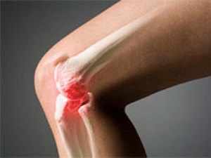 Способы лечения Артроза коленного сустава