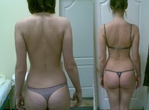 Сколиоз 1 степени