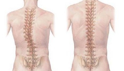 Сколиоз грудного отдела позвоночника