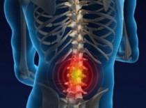 Остеохондроз 3 степени