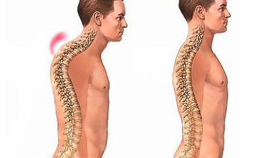 Сколиоз 3 степени