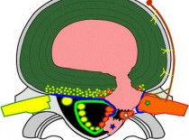 Секвестрированная грыжа позвоночника