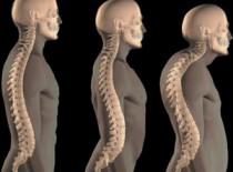 Образование кифоза