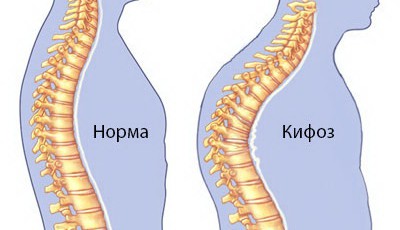 Кифоз 1 степени