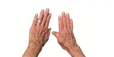 Деформирующий артроз кистей рук