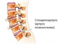 Артроз позвоночника