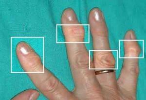 По статистике, артрозу менее всего подвержен большой палец кисти