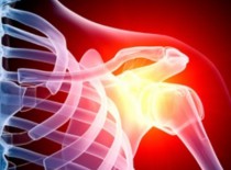 Артроз плечевого сустава