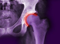 Коксартроз 3 степени