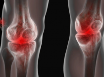 Артроз 1 степени