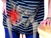 Коксартроз 2 степени