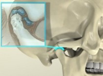Артроз челюстного сустава
