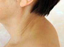 Горб на шее