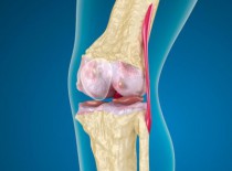 Пателлофеморальный артроз коленного сустава