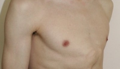 Килевидная грудная клетка