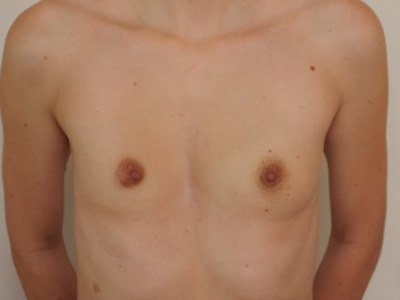 Уменьшение грудной клетки
